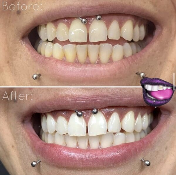 A before and after picture of teeth with braces.