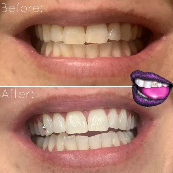 A before and after picture of teeth whitening