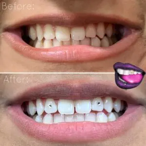 A before and after picture of teeth with purple lips.