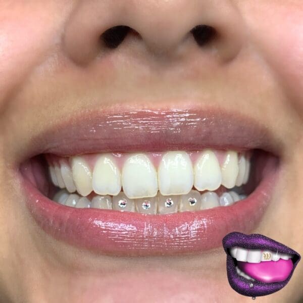 A woman with braces on her teeth and purple lips.