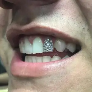 A man with braces on his teeth and smiling.