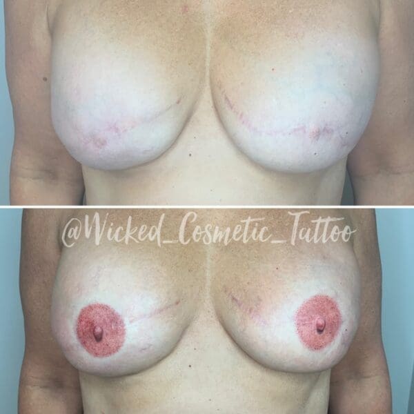 A before and after picture of breast implants