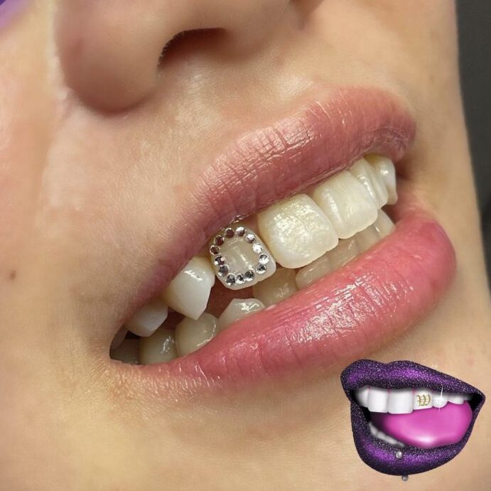 A woman with braces on her teeth and lips.